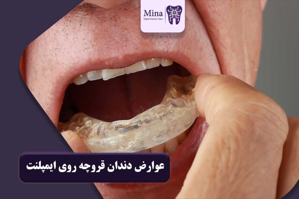 عوارض دندان قروچه روی ایمپلنت