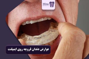 عوارض دندان قروچه روی ایمپلنت