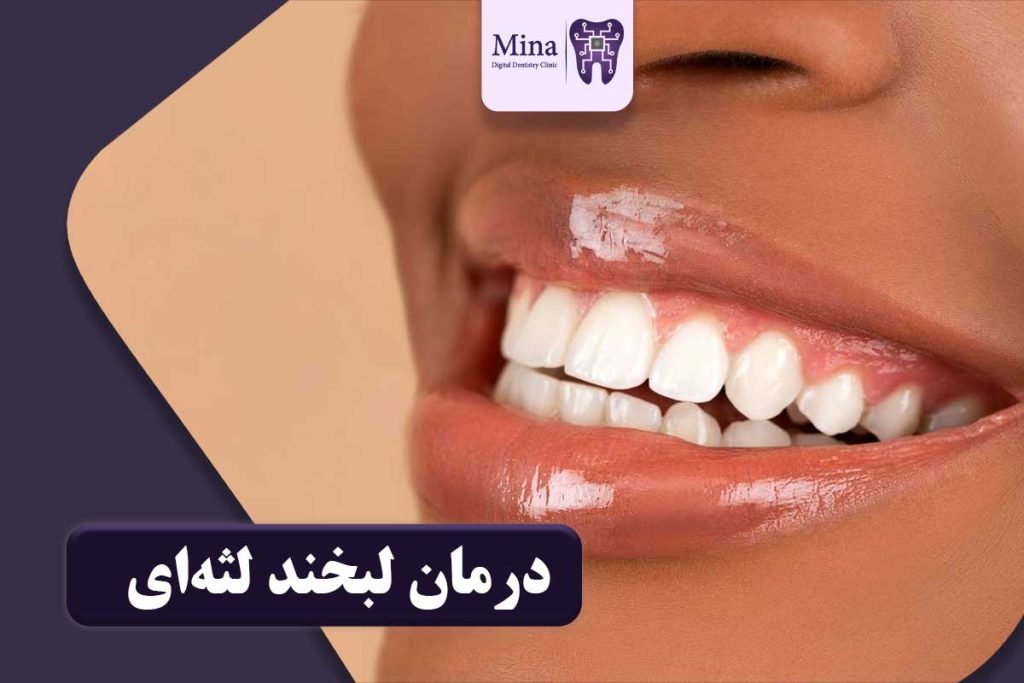 لبخند لثه‌ای