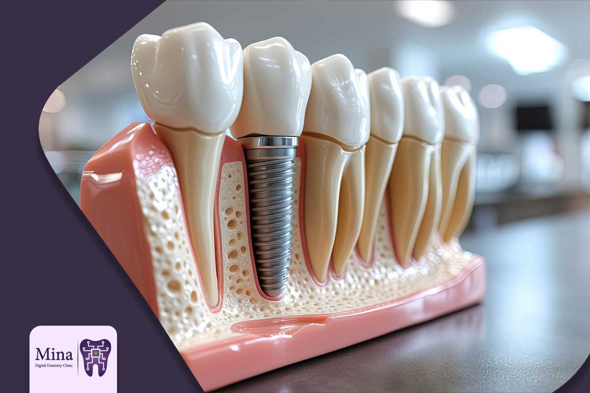 افزایش طول عمر ایمپلنت