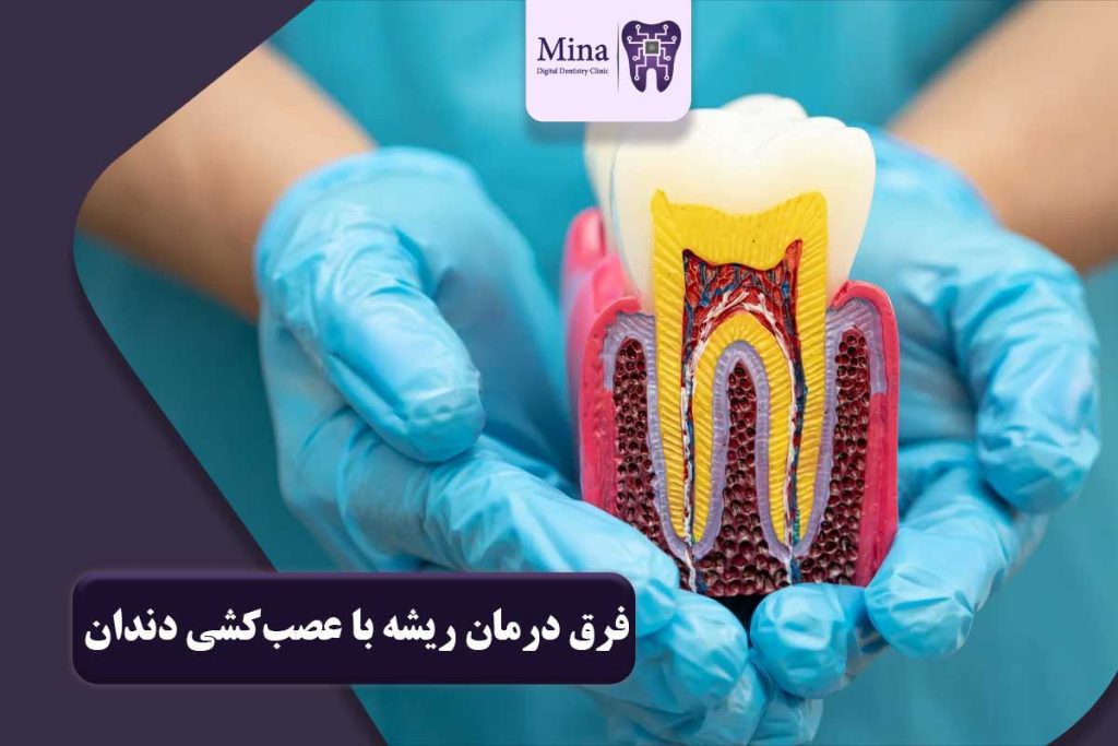 فرق درمان ریشه با عصب‌کشی دندان