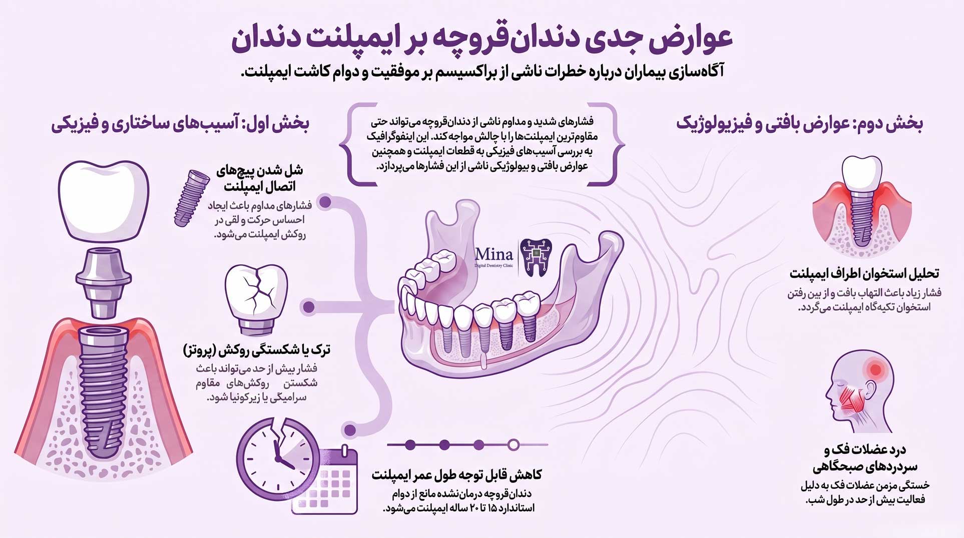 مهمترین عوارض دندان قروچه روی ایمپلنت