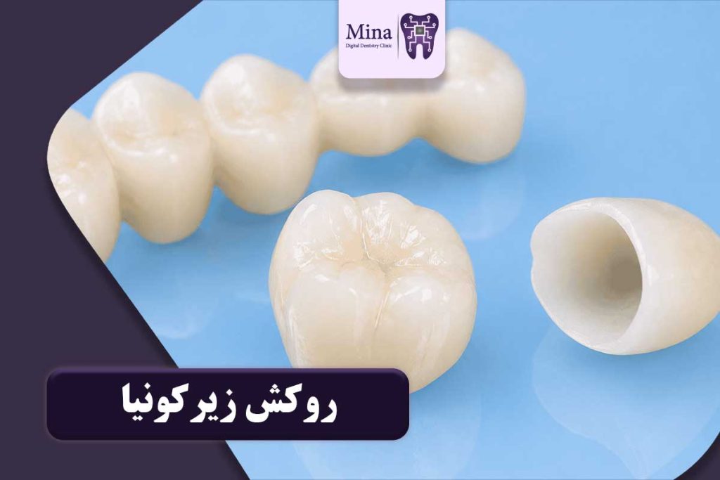 روکش زیرکونیا