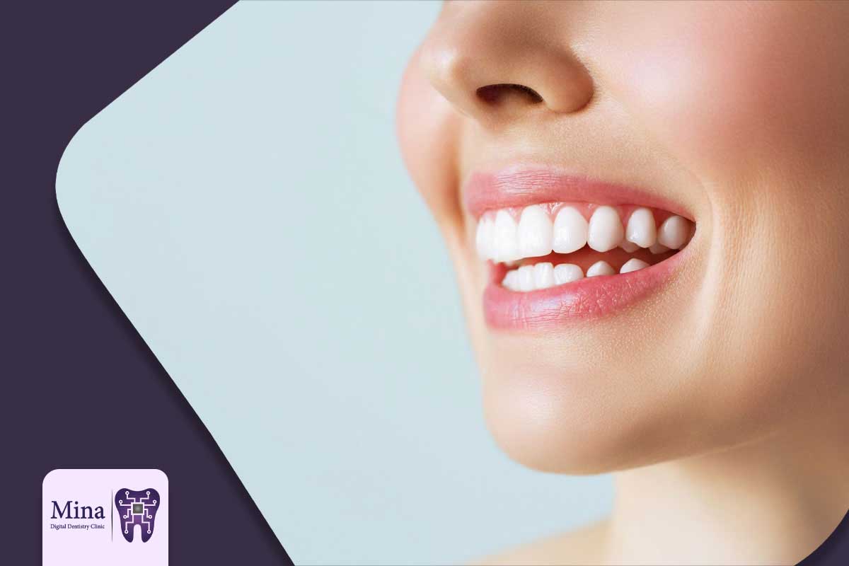 تکنیک پیشرفته لیرینگ (Layering) در ونیر کامپوزیت