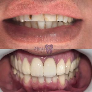 Anterior-tooth-veneers