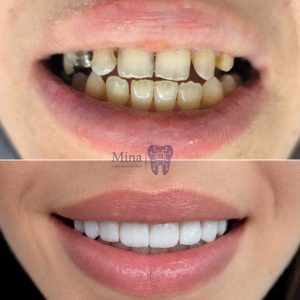 Before-and-after-ceramic-veneers