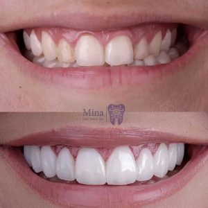 Before-and-after-dental-composite-bonding
