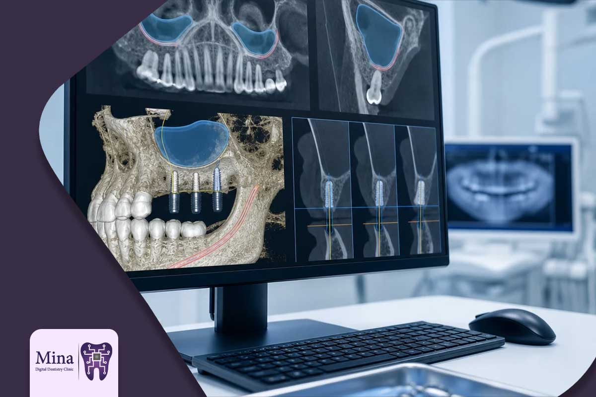 مزایای جراحی سینوس لیفت در ایمپلنت