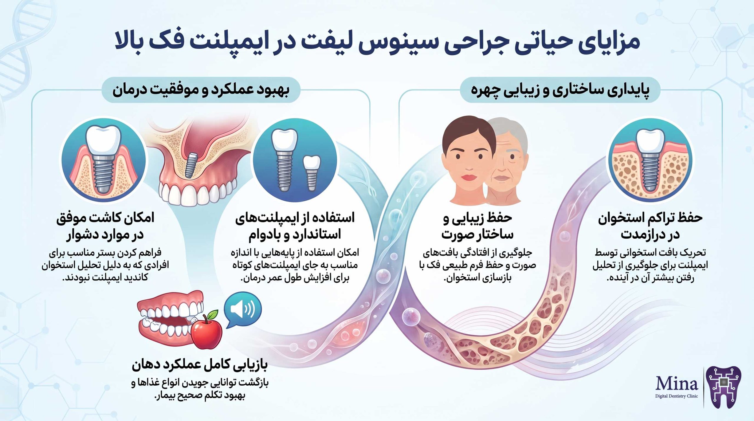 مزایای جراحی سینوس لیفت در ایمپلنت فک بالا