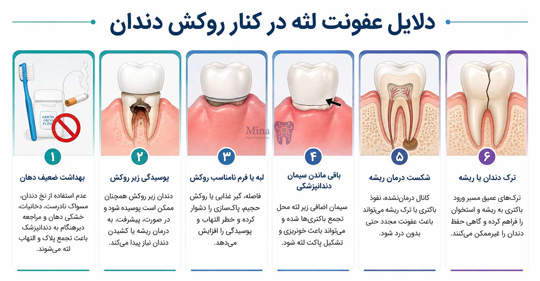 دلایل عفونت لثه در کنار روکش دندان