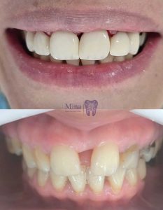 Closing-gaps-between-teeth-with-composite