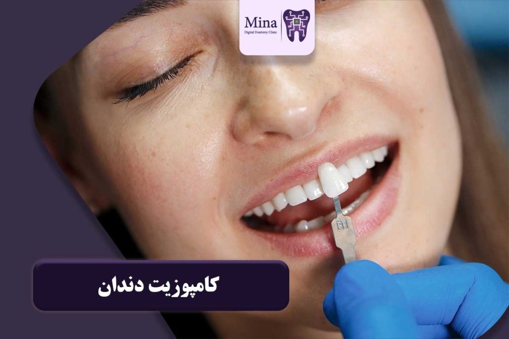 کامپوزیت دندان