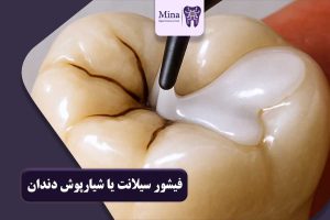 فیشور سیلانت یا شیارپوش دندان