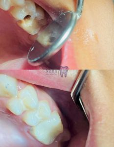 Dental-restoration-with-composite