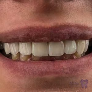 Final-result-and-the-patient's-smile-after-ceramic-laminates.