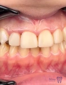 Front-tooth-composite