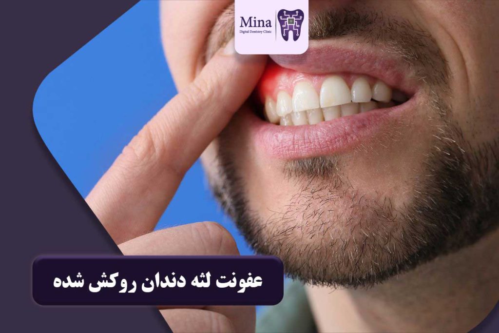 عفونت لثه دندان روکش شده