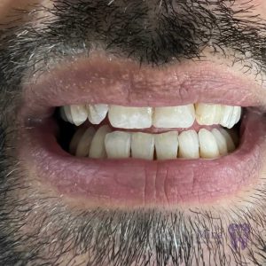 لبخند بیمار پس از ایمپلنت