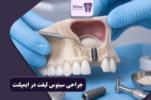جراحی سینوس لیفت در ایمپلنت