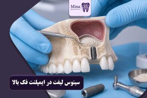 سینوس لیفت در ایمپلنت فک بالا