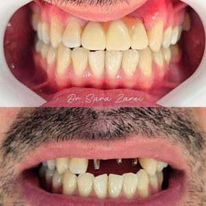 Before-and-after-3-unit-implants