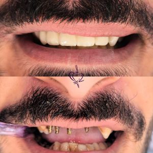 Before-and-after-implants