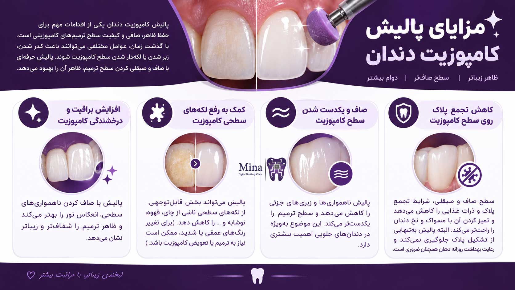 مزایای پالیش کامپوزیت دندان