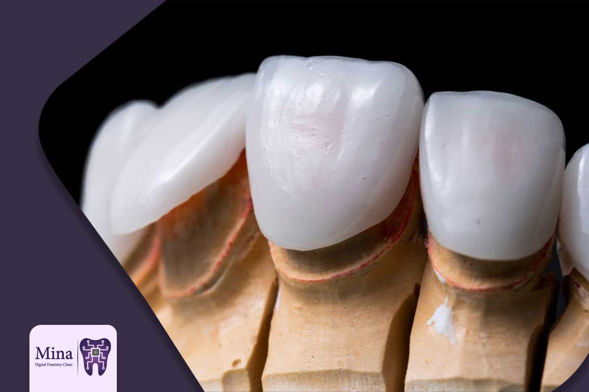 مراقبت از لمینت سرامیکی