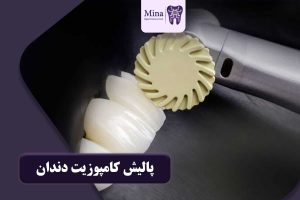 پالیش کامپوزیت دندان