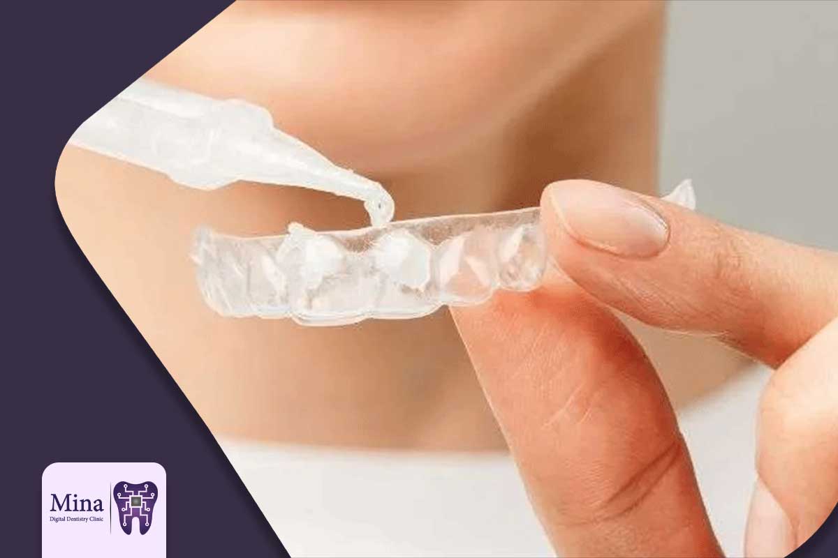 بلیچینگ مطب و بلیچینگ خانگی