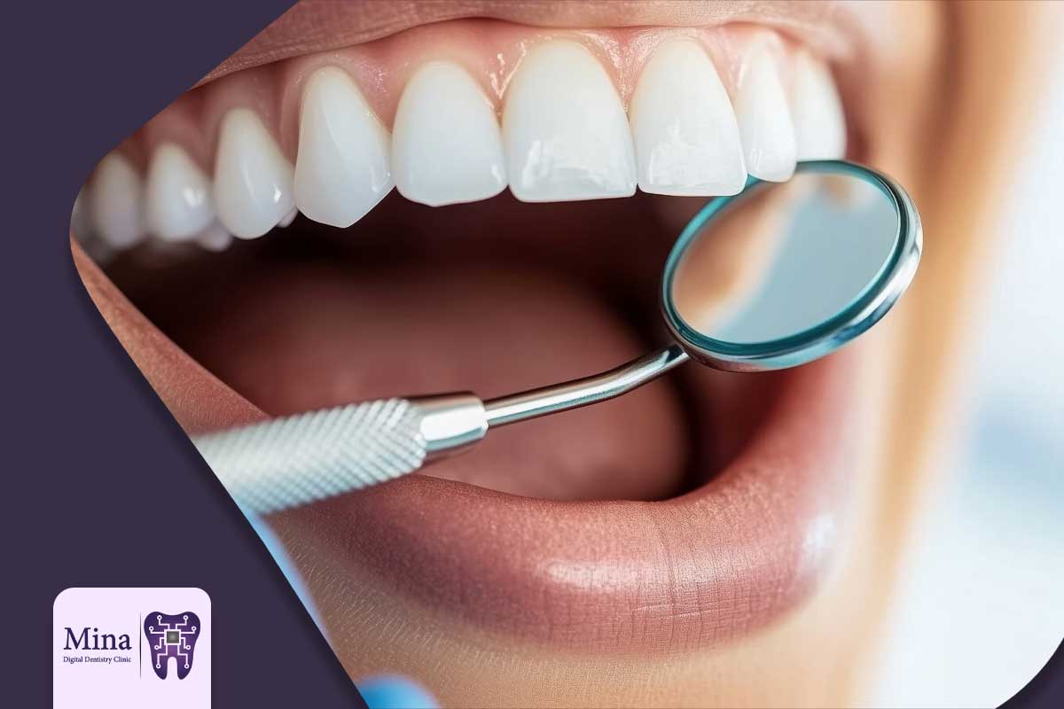 مراقبت های لازم بعد از پالیش کامپوزیت دندان