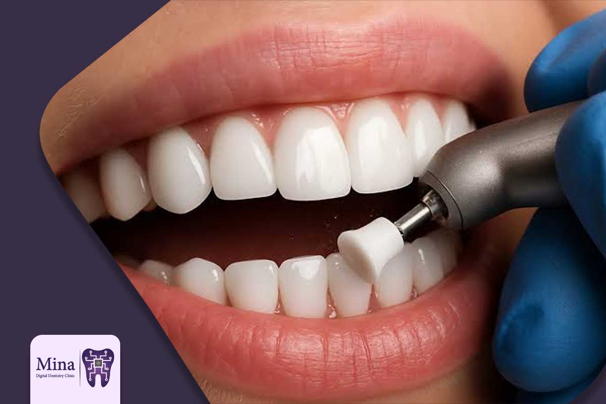 تفاوت پالیش کامپوزیت دندان با جرم گیری و بلیچینگ دندان