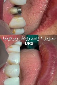 نمونه درمان روکش زیرکونیا