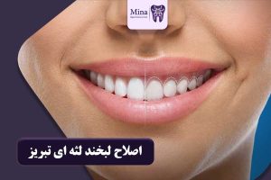 اصلاح لبخند لثه ای تبریز