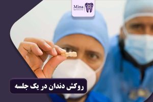 روکش دندان در یک جلسه